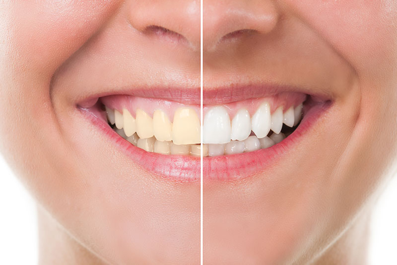 Teeth Whitening - First Choice Family Dental Office, San Jose Dentist